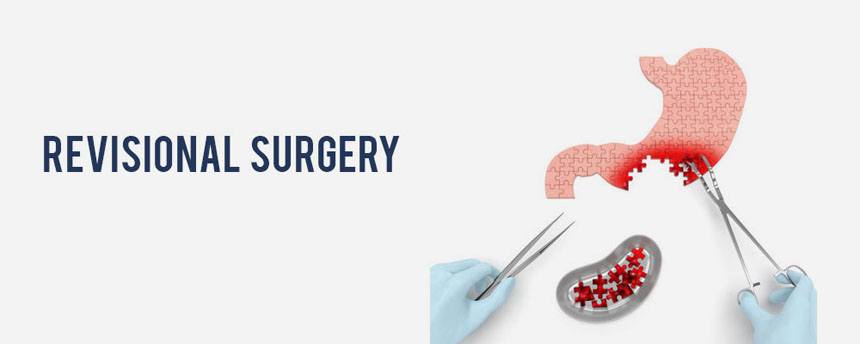 Revisional Weight Loss Surgery Meerut