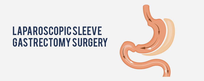 Laparoscopic Sleeve Gastrectomy Surgery in Meerut