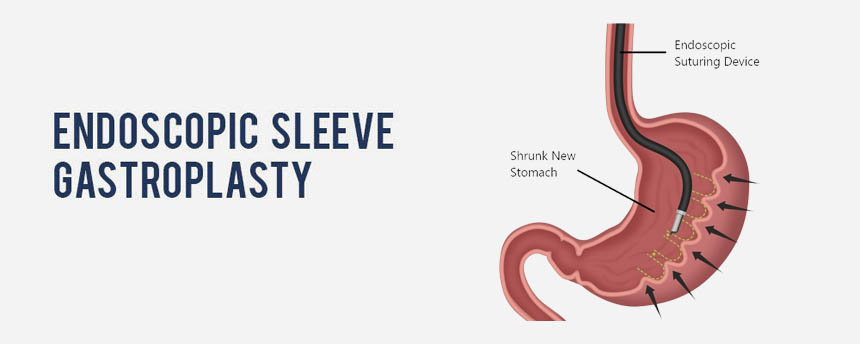 Endoscopic Sleeve Gastroplasty Meerut